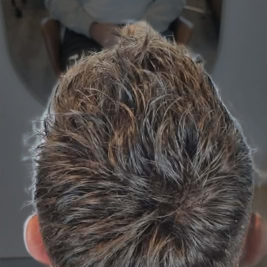 Close-up of a client's hairline after their Tuffs hair system